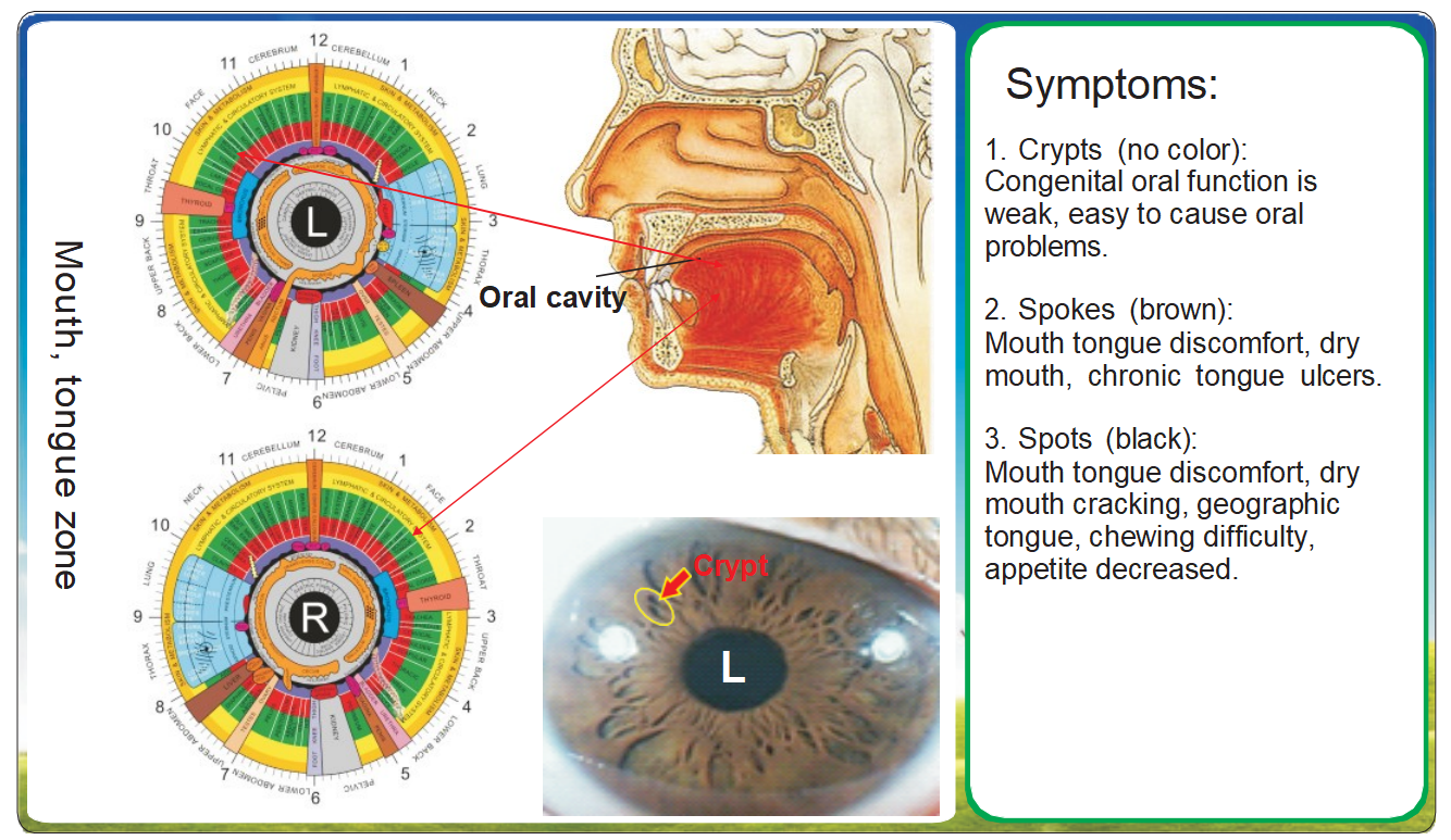 Capítulo 8: Zonas de reflexo em iridologia e os oito sistemas corporais – 8.1 Sistema Digestivo (Caso 1)
