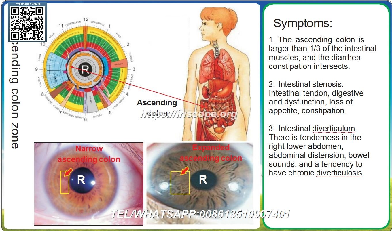 8.1 Iridologia: Colon Ascendente Estreito e Colon Ascendente Expandido – Caso 4