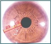 Ilustração da Iridologia – Capítulo 3.2: 3.1 Anel Gástrico