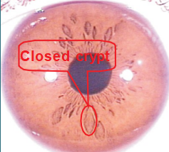 Chapter 6 The major iris signs and marking 001