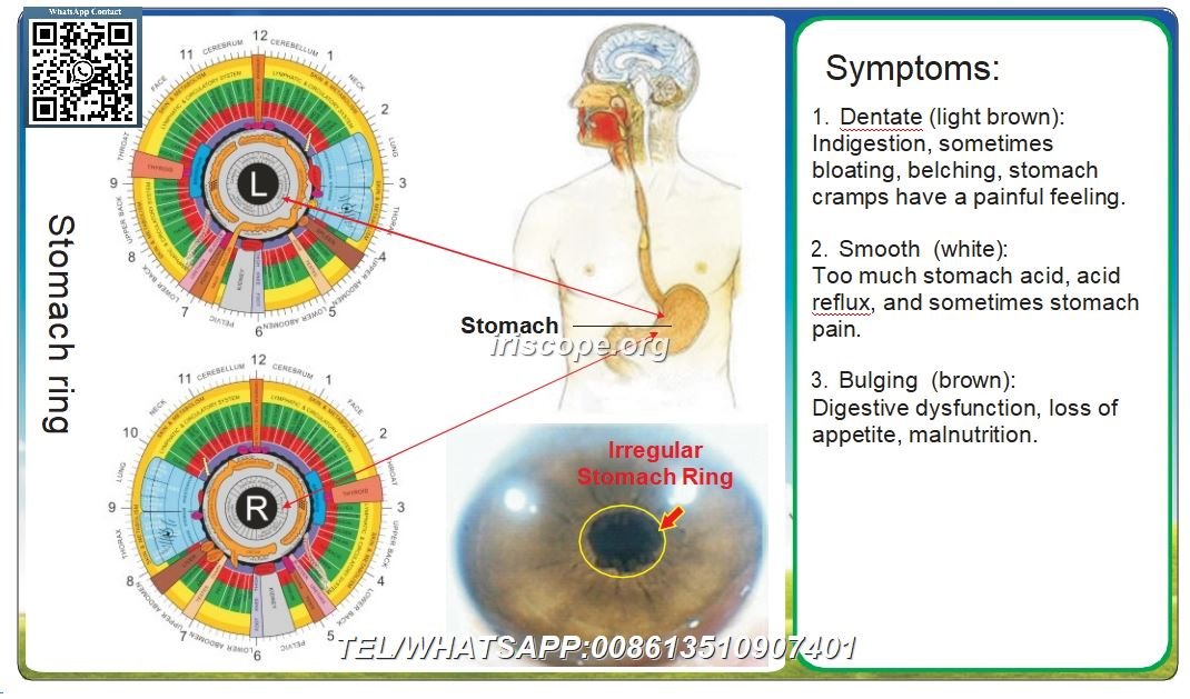 Capítulo 8 Zona de Reflexo em Iridologia e os Oito Sistemas Corporais – 8.1 Sistema Digestivo Caso 2