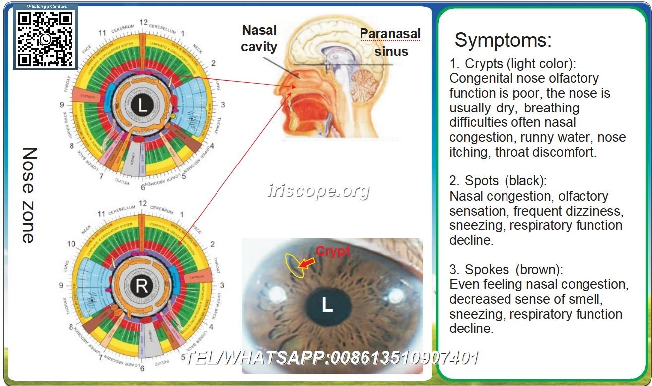 Capítulo 8 Zona de reflexão em iridologia e os oito sistemas corporais – 8.1 Sistema Respiratório Caso 1
