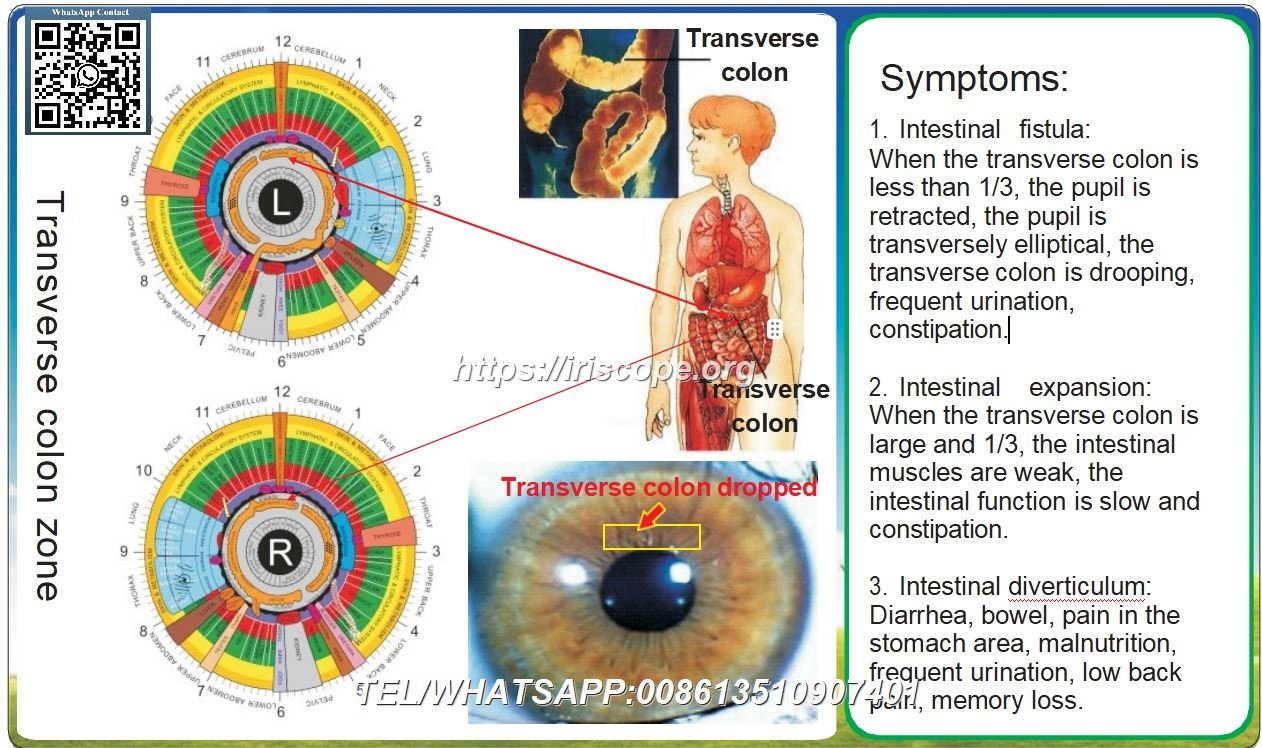 8.1 Iridologia – Cólon Transverso: Estudo de Caso 8