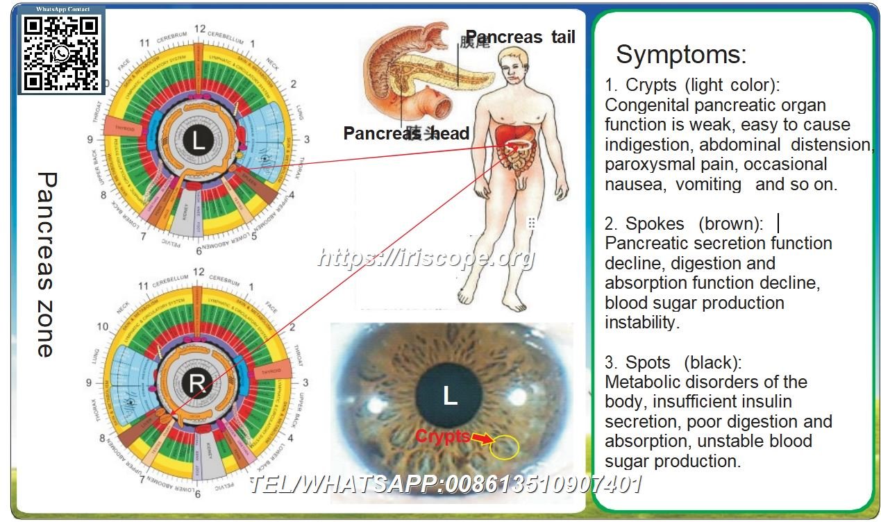 8.1 Iridologia – Zona Pancreática: Decifrando Sinais de Risco para Disfunções Metabólicas