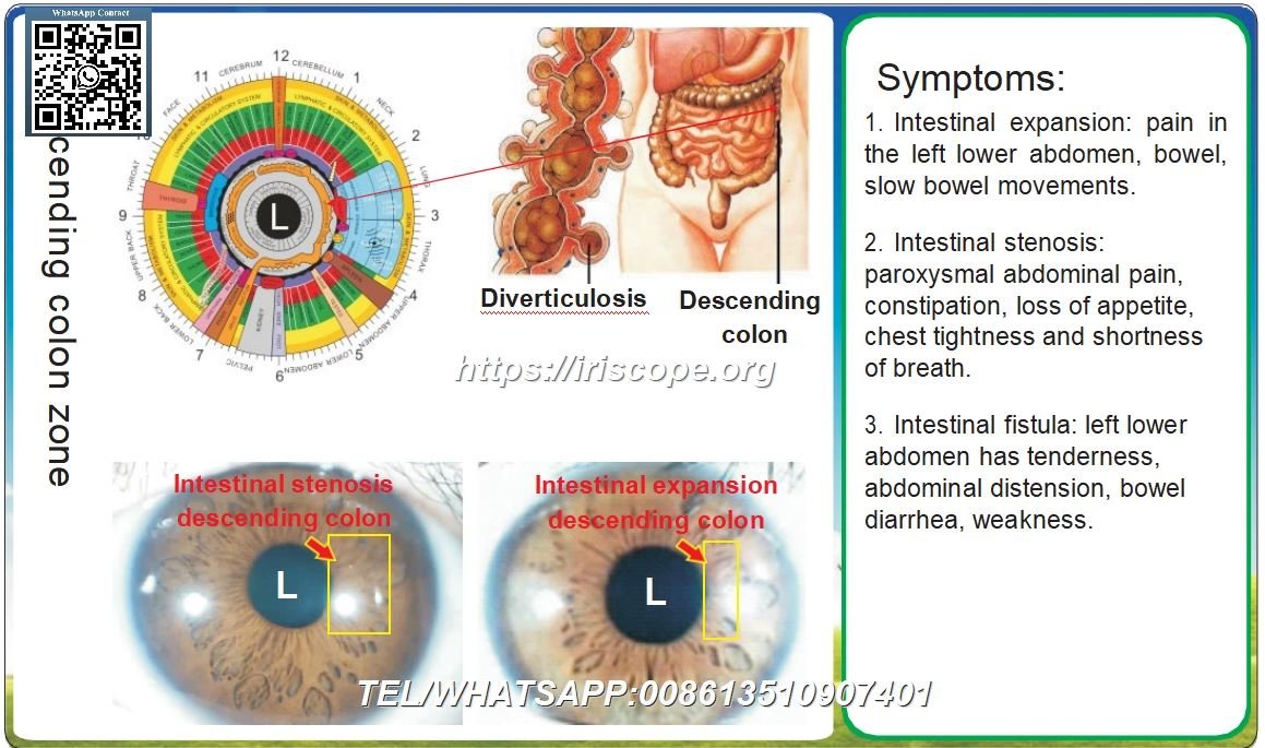 Iridology and Colonic Pathologies A Comprehensive Clinical Analysis Case 9 1