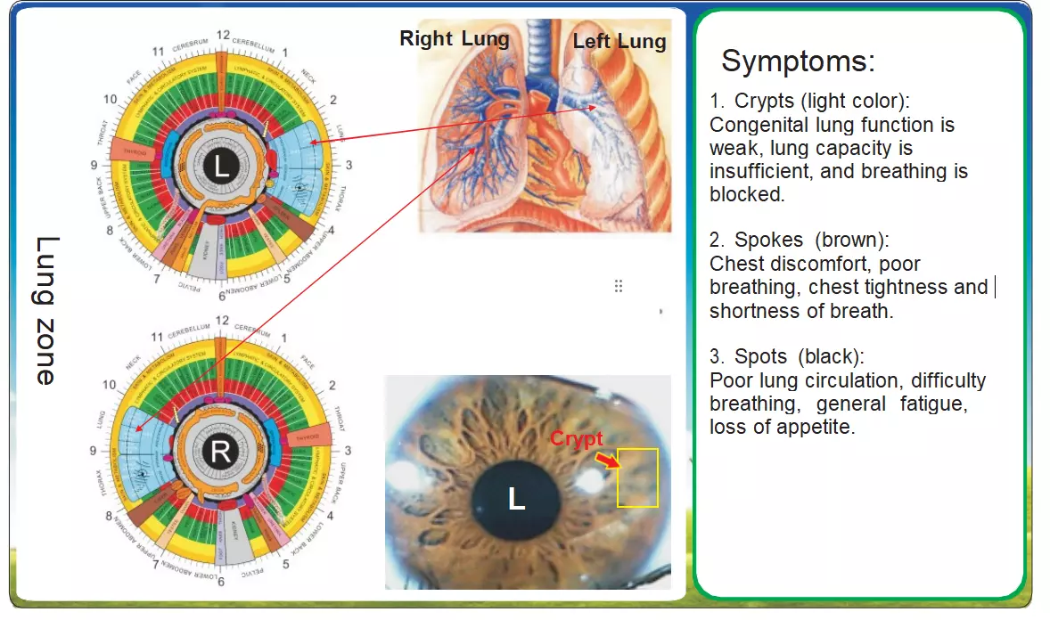 Iridologia na Avaliação Pulmonar – Uma Análise Comparativa