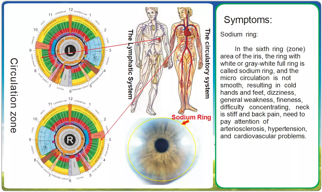 Iridologia e o Anel de Sódio: Decifrando Sinais Circulatórios na Íris Uma Análise Integrada dos Sistemas Linfático e Cardiovascular através da Iridologia