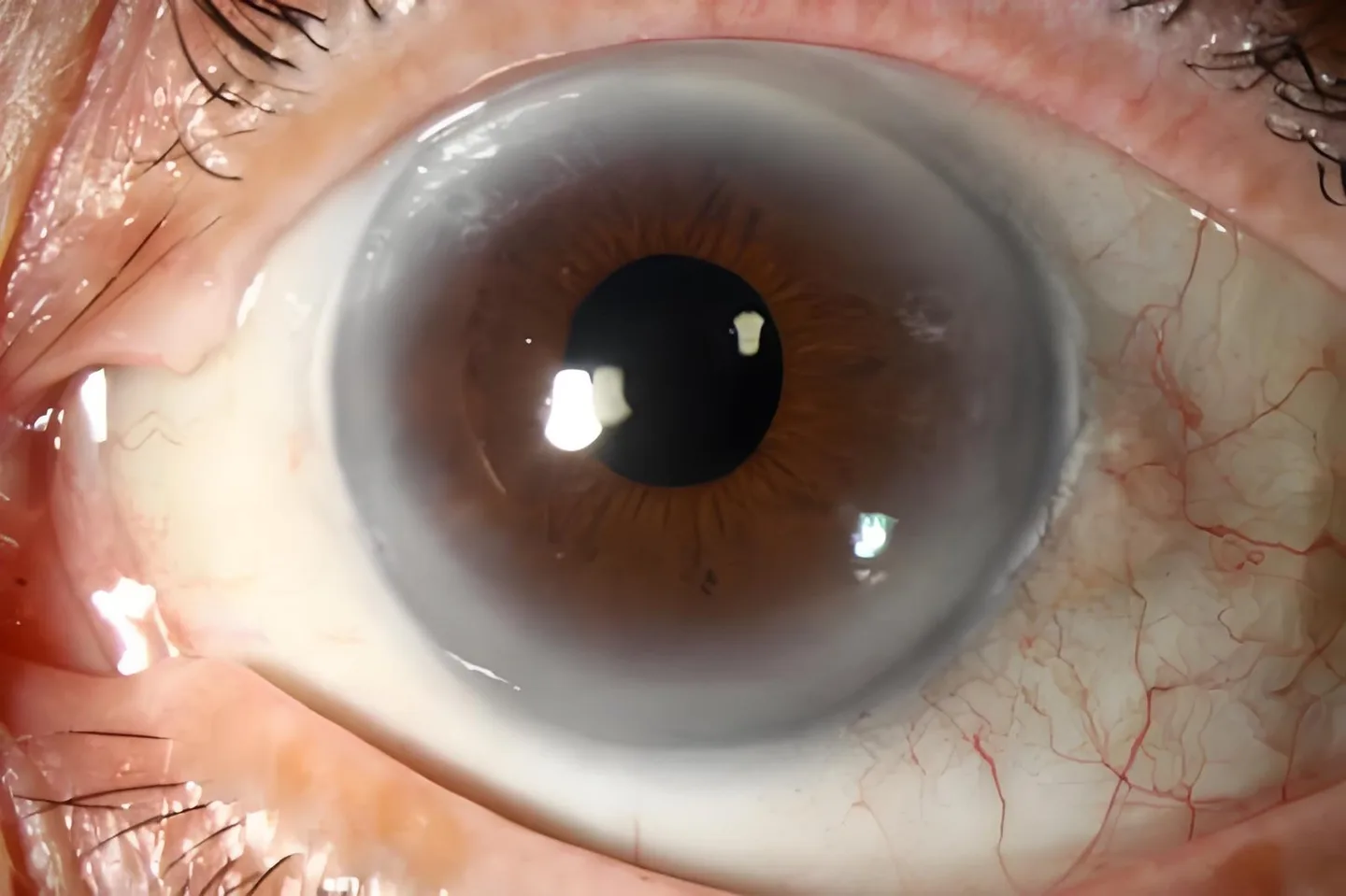 Mapa de iridologia: guia operativo para fornecedores de equipamentos em Portugal — Iridology Iris sodium ring (4).jpg