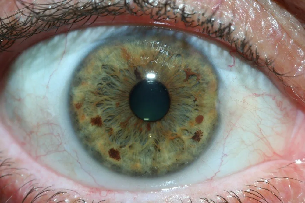 MAIKONG 5MP Iridology camera MK 980U MK 980U 13 MAIKONG 5MP Iridology camera MK 980U MK 980U — iridology images 20.jpg