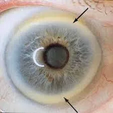 Como integrar software de iridologia em apresentações e aulas em Portugal — Iridology Iris sodium ring (2).jpg