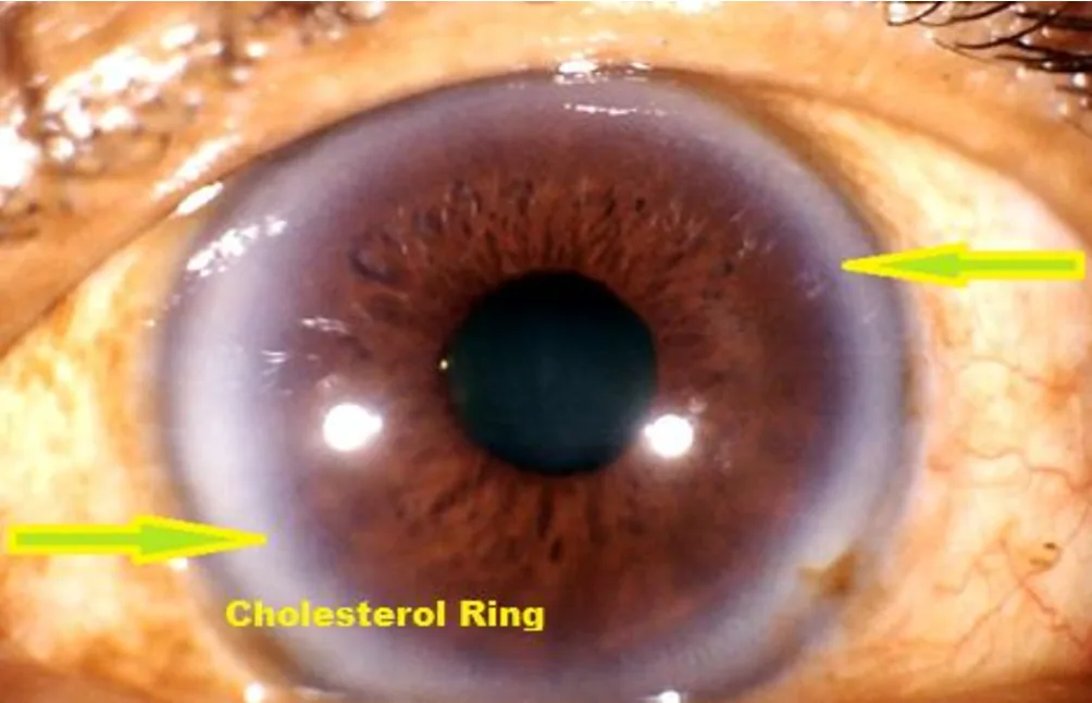 Como integrar software de iridologia em apresentações e aulas em Portugal — Iridology Iris sodium ring (1).png
