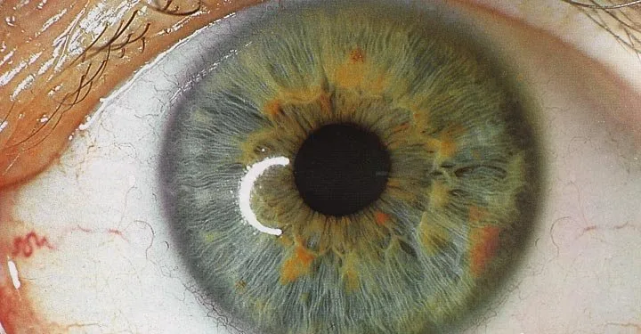 iriscopio — iridology treatment images.jpg
