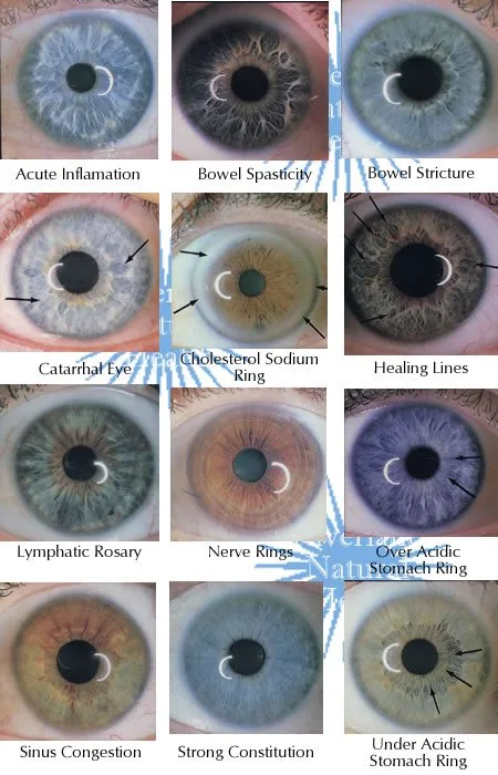 iriscopio — iridology examples numerous.jpg