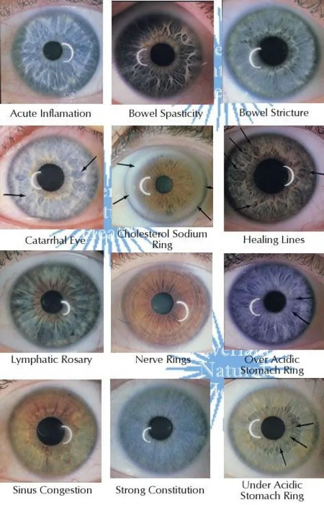 iriscopio — Iridology before and after (10).jpg